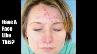 Home Remedies For Acne - Cure Your Acne In Natural Way At Home