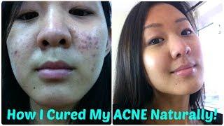 How I Cured My ACNE Naturally (10 Tips)